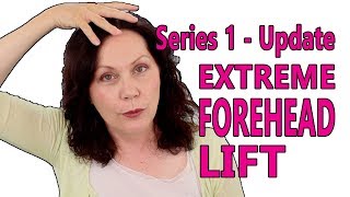 Forehead Wrinkles Removal - Facerobics Facial Exercises