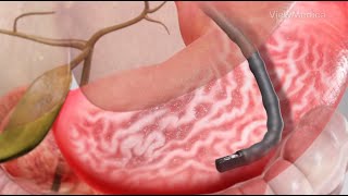 ERCP