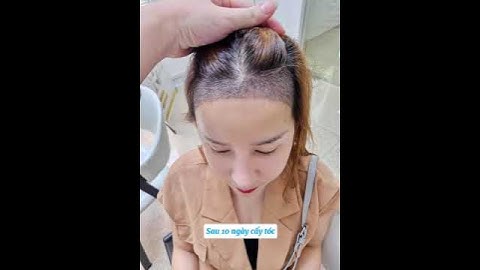 HÀNH TRÌNH CẤY TÓC: KHÔNG ĐẸP TỰ NHIÊN THÌ MÌNH ĐI THẨM MỸ