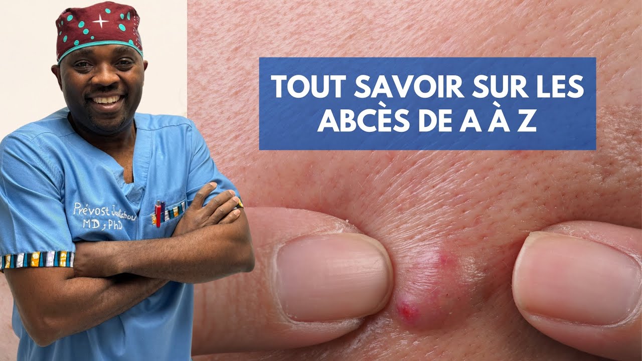 Tout savoir sur les #abcès et votre #santé par @Docteur Sourire