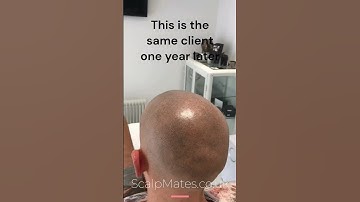 Soft, Natural Hairline: 1-Year Results of #ScalpMicropigmentation #SMP #hairlinerestoration #shorts