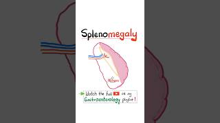 Splenomegaly - Hepatosplenomegaly - Liver Cirrhosis - Liver Function Tests (LFTs), Albumin, ALT, AST