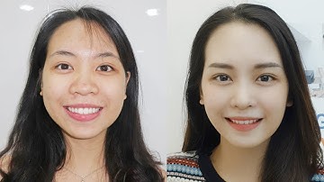 NIỀNG RĂNG KHIẾN CÔ GÁI TRẺ "LỘT XÁC" BẤT NGỜ - HÃY XEM NẾU ĐỊNH NIỀNG RĂNG