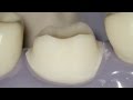 #30 tooth prep