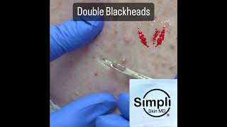 Double Blackhead Extraction Satisfaction