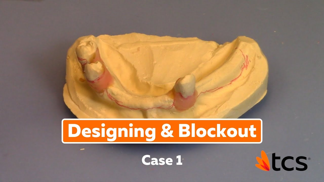 Designing & Blockout Case 1 - Major Blockout, Challenging Path of Insertion, Three Teeth Remaining