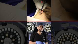 Inside Gynecomastia Surgery: Essential Instruments for Gland Removal | Dr Dhruv Chavan, Pune
