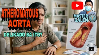 Ano ang Atheromatous Aorta? Delikado Ba Ito? 