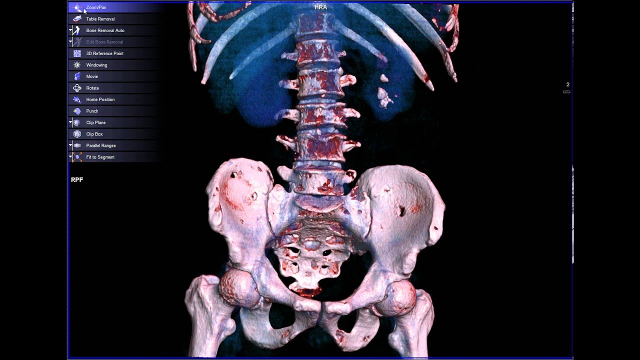 CT SCAN OF VERTEBRAE LUMBAR (3D) - YouTube