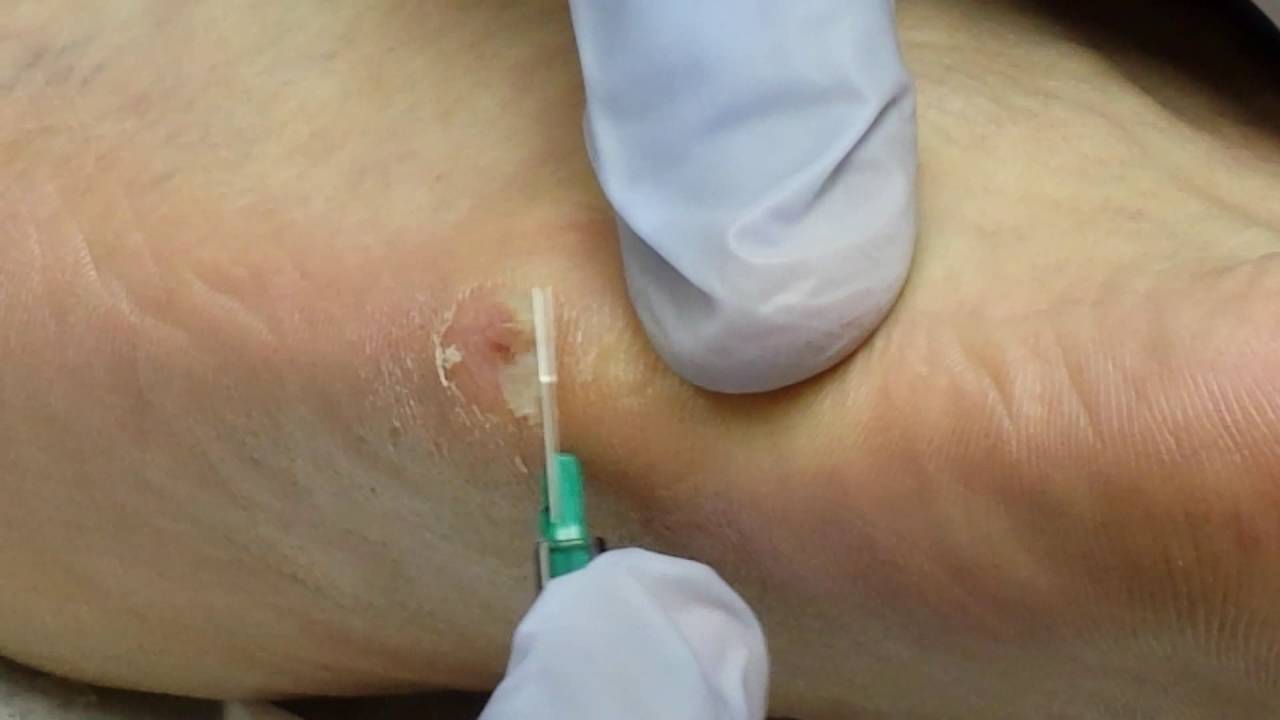 freeze away wart remover - YouTube