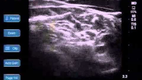 Cervical Plexus block, Interscalene block & suprascapular Nerve block for shoulder surgery