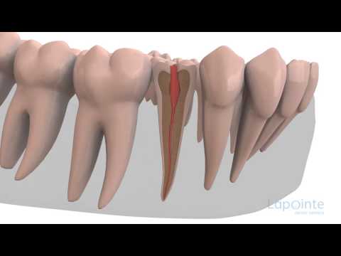 Pulpotomy - Lapointe dental centres