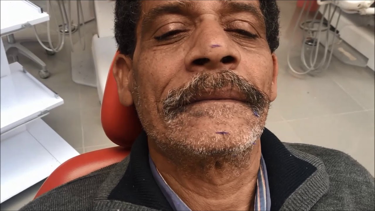 Part II of bite Registration for completely edentulous patient ( vertical , centric relations