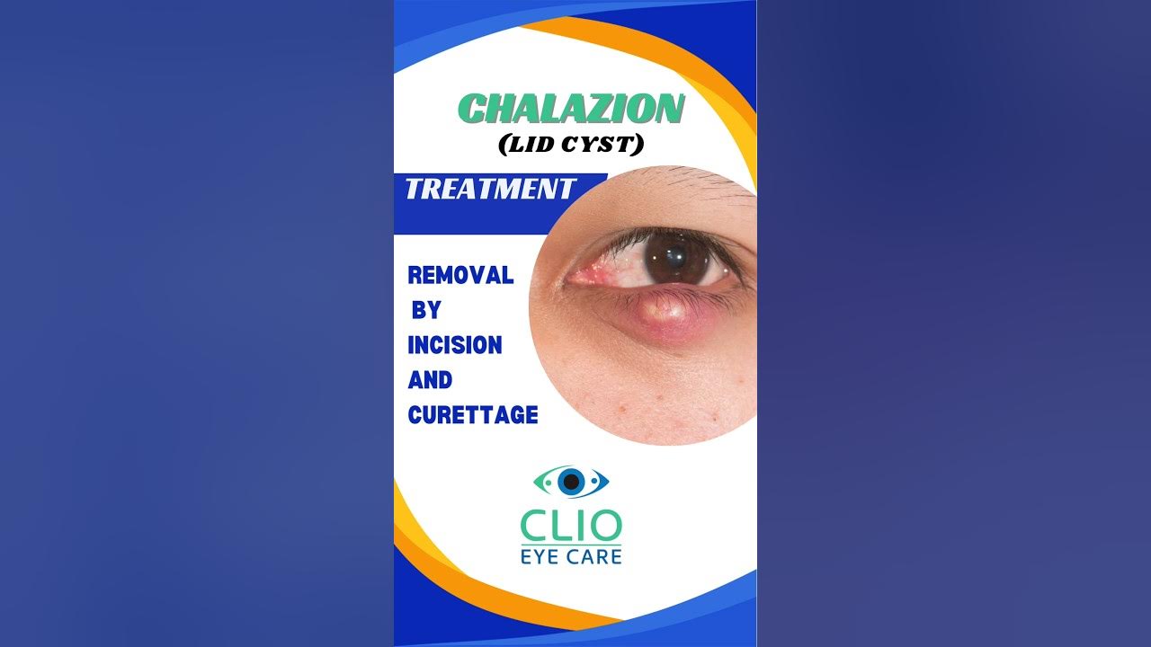 chalazion-treatment-incision-and-curettage-clio-eye-care-youtube