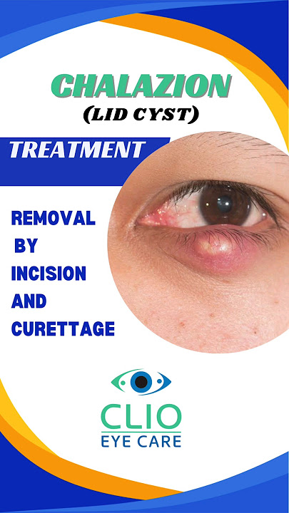 Chalazion Treatment- Incision and Curettage | CLIO Eye Care