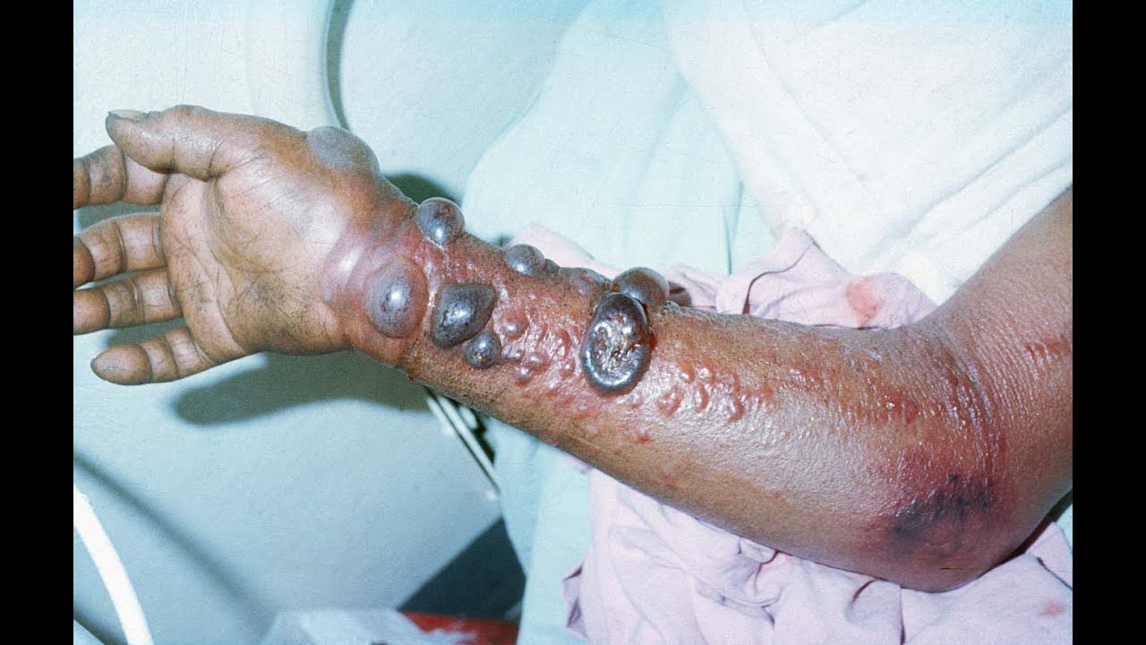 Pictures of the effects of ebola - People in the us Pictures of the effects of ebola - People in the us