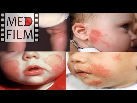 Лечебное питание, аллергии, атопический дерматит © Therapeutic nutrition of the child
