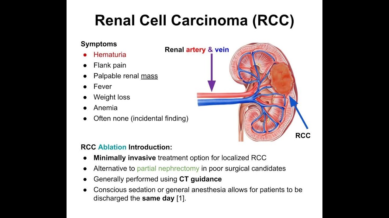 Renal Cell Carcinoma (Type of Kidney Cancer) ; Definition, Causes ...