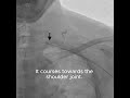 The TAME Lab: Suprascapular artery cathetherization