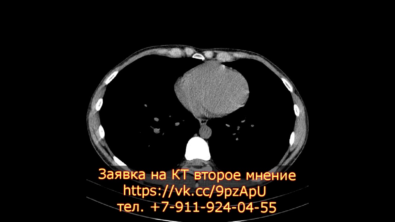 Левосторонняя нижнедолевая пневмония на расшифровке КТ грудной клетки и легких