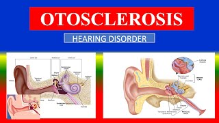 OTOSCLEROSIS - Definition , types , cusses , Pathophysiology , signs , diagnoses,  treatment