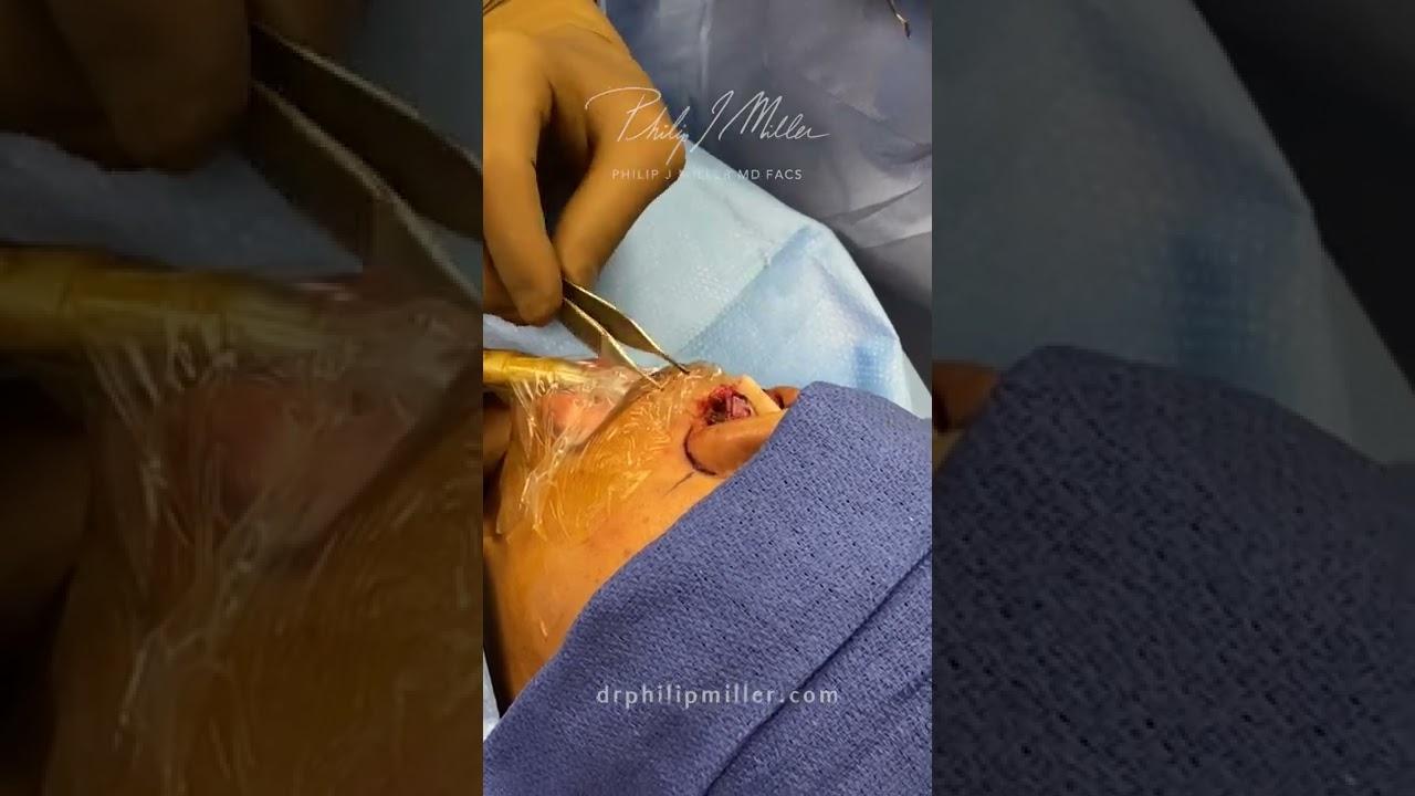What Is A Vertical Strut Graft? Let me explain VIEWER DISCRETION ADVISED