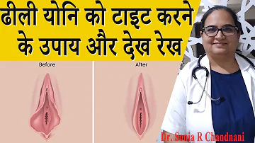 Tighten Loose Vagina? | ढ़ीली योनि को टाइट कैसे करें जानें कारण,लक्षण,और इलाज |Dr. Sonia R Chandnani