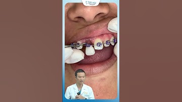 Răng Thưa, Mất Răng Có Niềng Răng Được Không ? | Bác Sĩ Yên