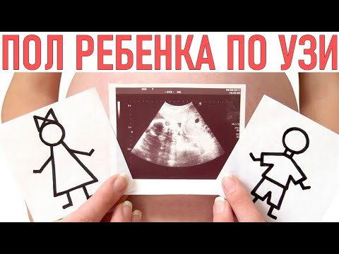 ПОЛ РЕБЕНКА ПО УЗИ | Ошибки в определении пола ребенка | Точность определения пола