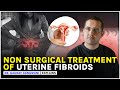 3 NON SURGICAL TREATMENT OF UTERINE FIBROIDS Dr Gaurav Gangwani Interventional Radiologist 3 NON SURGICAL TREATMENT OF UTERINE FIBROIDS Dr Gaurav Gangwani Interventional Radiologist