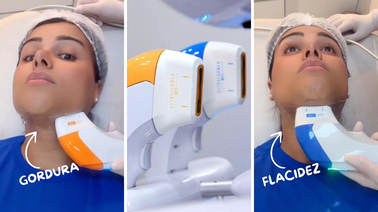 Testando tratamento para eliminar a papada: ULTRAFORMER MPT