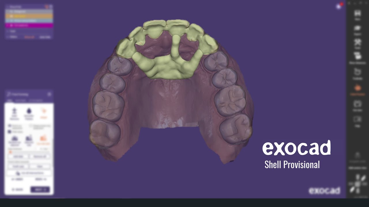Exocad Shell Provisional Tutorial - YouTube