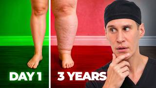 Does Lipedema Really Return After Liposuction? (The Truth)