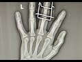 Middle finger fracture dislocation managed with Suzuki frame