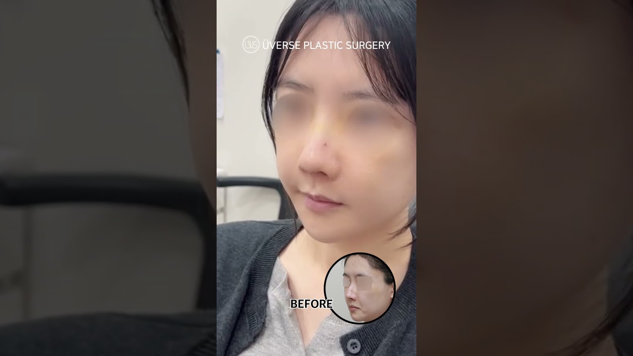 [Веберс гоо сайхны мэс заслын эмнэлэг] Хамрын мэс засал туухай авах 💚 7 дахь өдөр