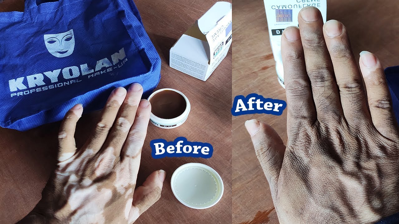 Best Makeup for Vitiligo Waterproof Camouflage Cream YouTube