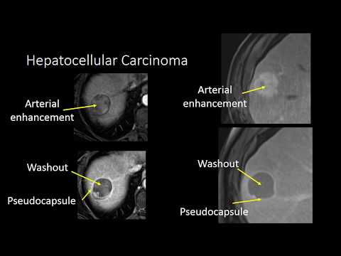 GI Imaging - Cirrhosis