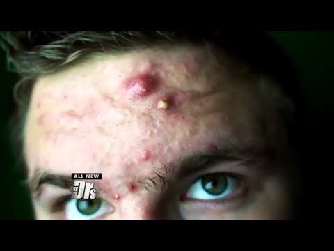 Severity of My Acne Got Me Blasted On TV!