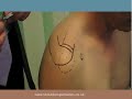 Shoulder Injections in General and Physiotherapy Practice