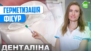 Як Захистити Зуби Від Карієсу? Що Таке Герметизація Фісур? Поради Лікаря Стоматолога.