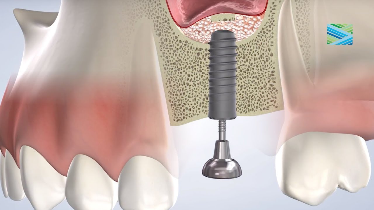 Bone Graft Aftercare at Napa Sonoma Oral Surgery & Dental Implants YouTube