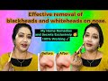 Blackheads  whiteheads   tips use    rekhas diary