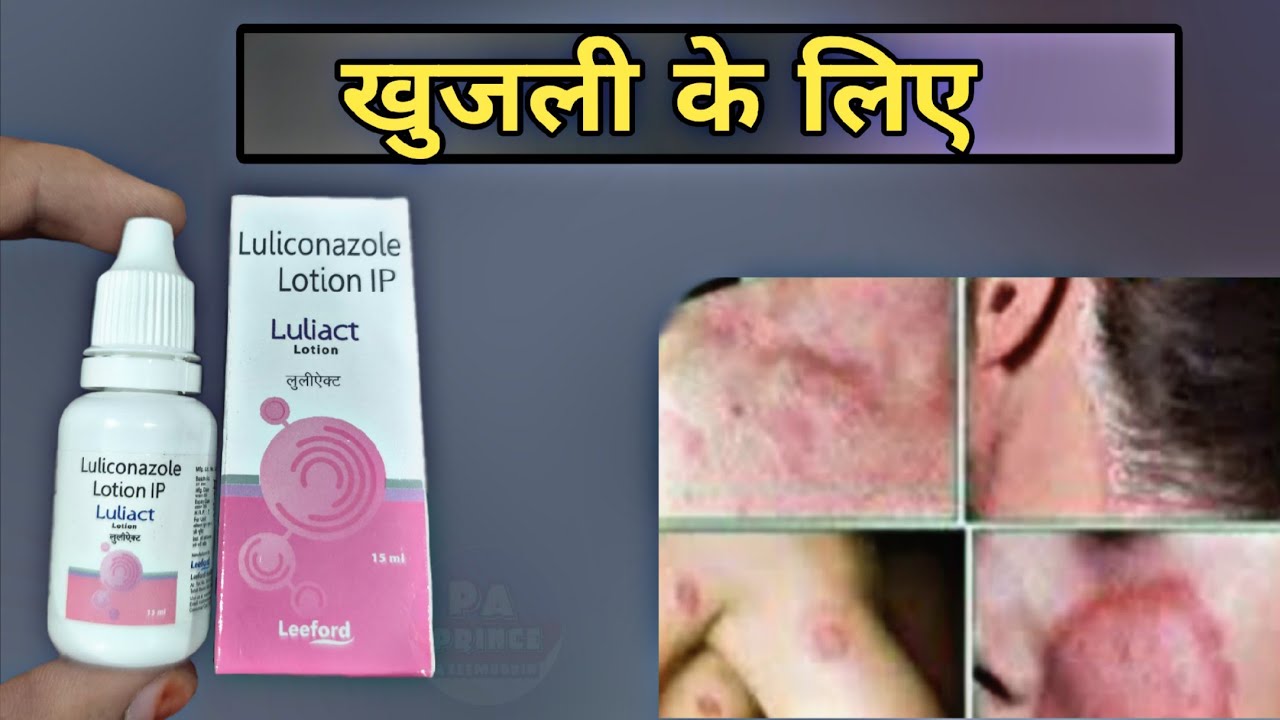 Fungal infection ,को जड़ से ख़त्म करे | Luliconazole Lotion Review | luliconazole | luliconazole cream