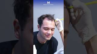 Hair Transplant in Istanbul | Medart