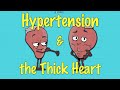 Left Ventricular Hypertrophy (LVH) and Hypertension