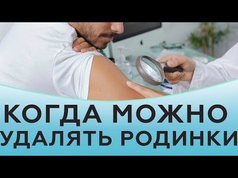 Когда можно удалять родинки