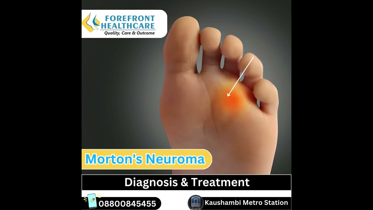 Morton’s neuroma diagnosis and treatment in kaushambi metro station Ghaziabad. 