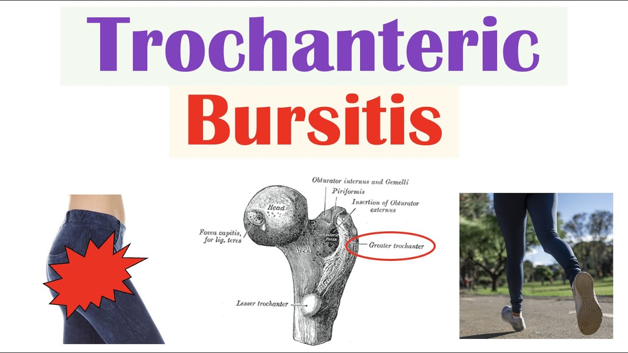 Causes and Symptoms of Trochanteric Bursitis