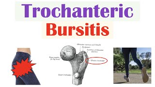 Trochanteric Bursitis (Greater Trochanteric Pain Syndrome) | Causes, Symptoms, Diagnosis, Treatment