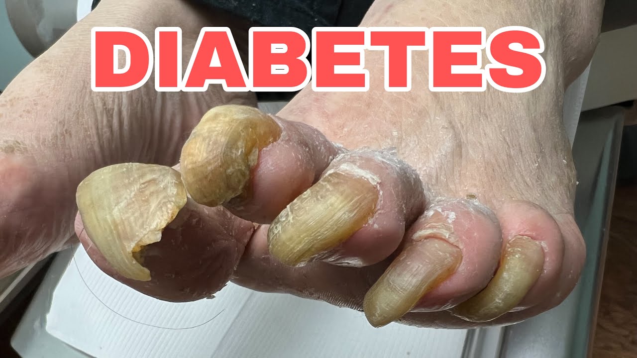 Trimming Those Tricky Diabetic Toenails